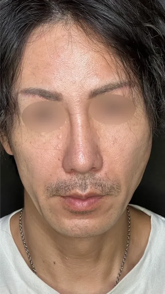 鼻整形_鼻尖形成オープン法+鼻尖軟骨移植+鼻プロテーゼ+鼻翼縮小内外側引き締め法術後1ヶ月(名医の坂本優衣医師が執刀)(158)