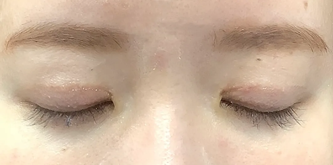 二重整形_二重全切開(切開時埋没抜糸)術後3ヶ月閉眼(名医の飯田秀夫医師が執刀)(84)