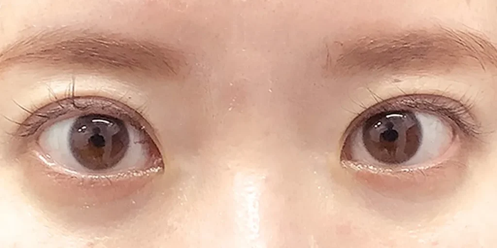 二重整形_二重全切開(切開時埋没抜糸)術後3ヶ月(名医の飯田秀夫医師が執刀)(84)