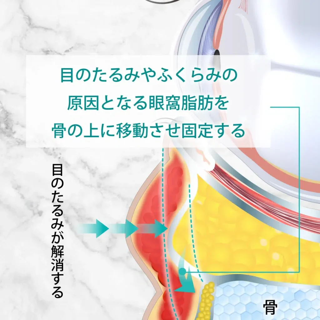 眼窩脂肪の図解