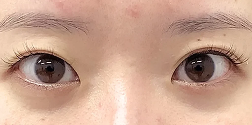 二重整形_二重全切開(切開時埋没抜糸)術前(名医の飯田秀夫医師が執刀)(84)