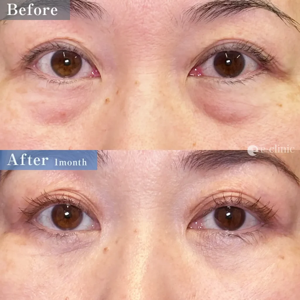 クマ取り_裏ハムラ法（坂本優衣）（32）