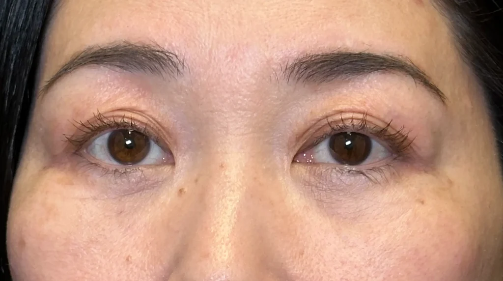 クマ取り_裏ハムラ法術後1ヶ月(名医の坂本優衣医師が執刀)(32)