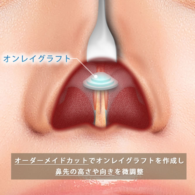 肋軟骨移植のオンレイグラフト