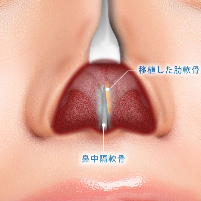 肋軟骨移植による鼻中隔延長