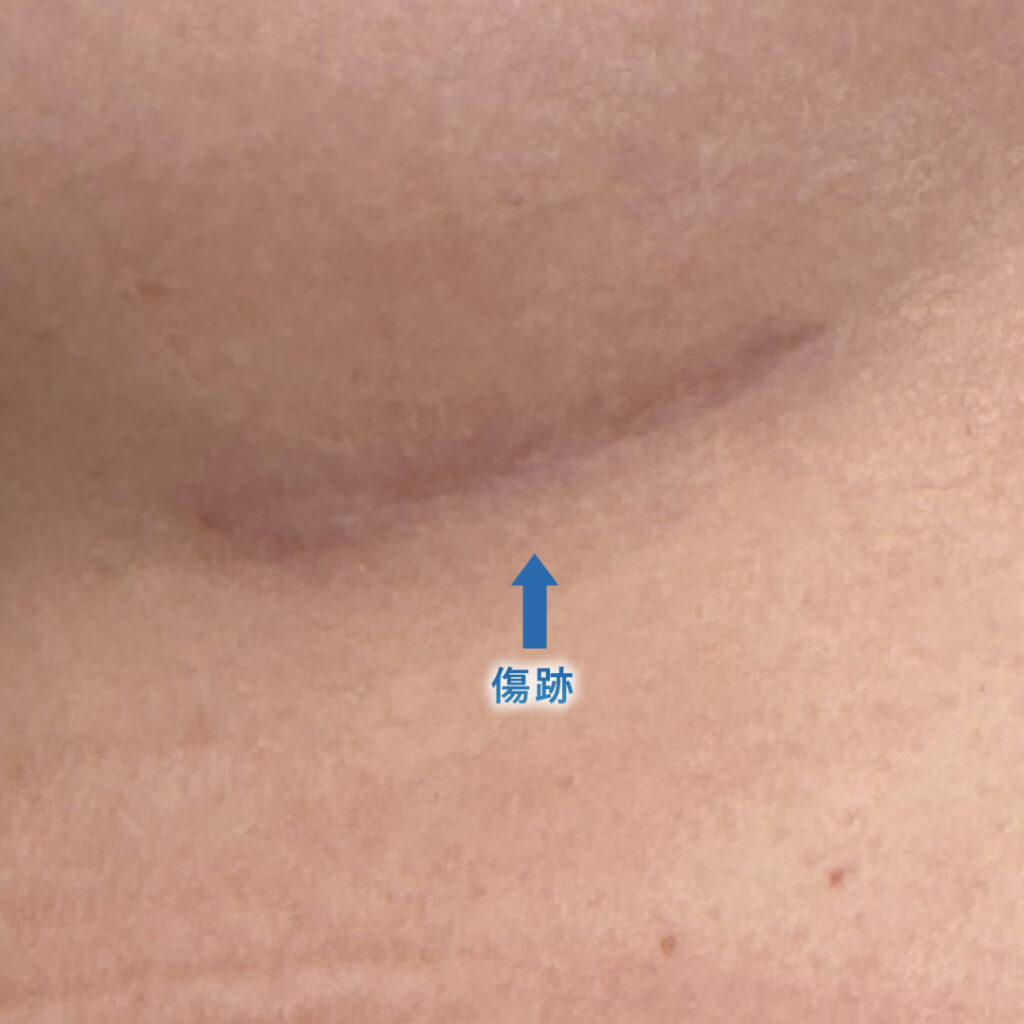 6ヶ月後の肋軟骨の採取部分の傷跡