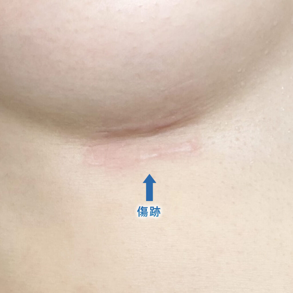 6ヶ月後の肋軟骨の傷跡