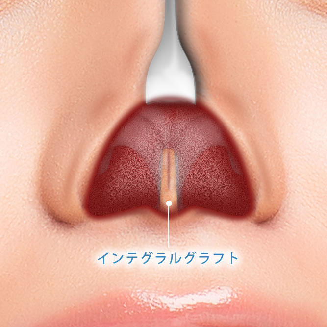 6ヶ月後の肋軟骨の傷跡