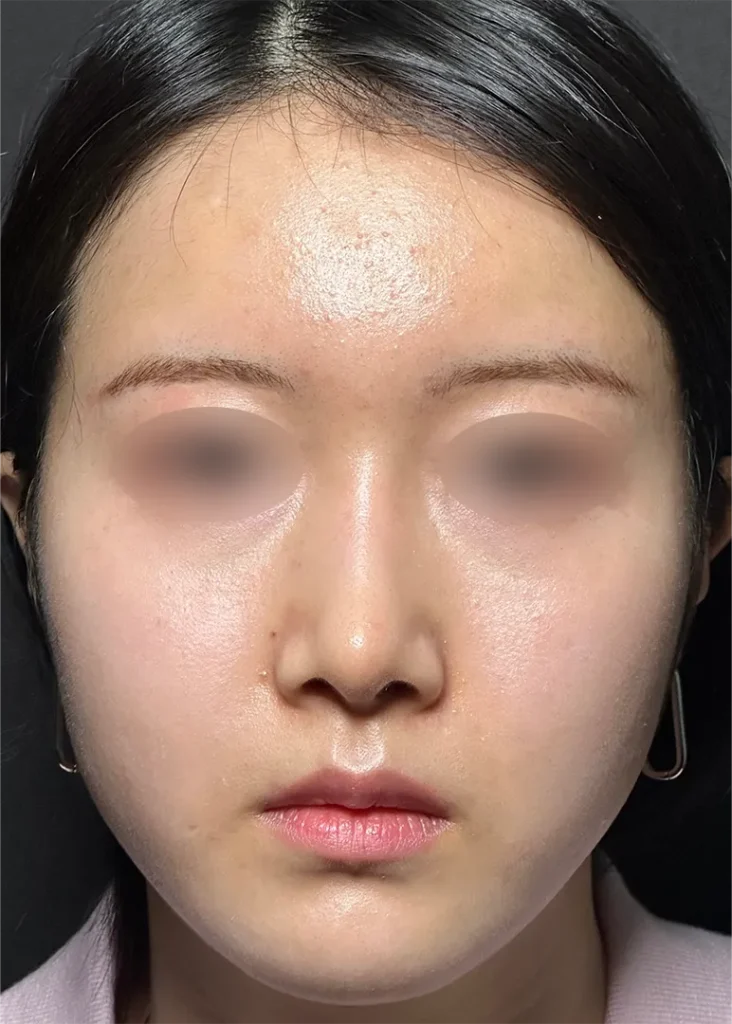 鼻整形_鼻尖形成3D法＋鼻尖軟骨移植＋鼻プロテーゼ＋小鼻縮小 内外側法 引き締め法　正面術後3ヶ月（坂本優衣）（268）