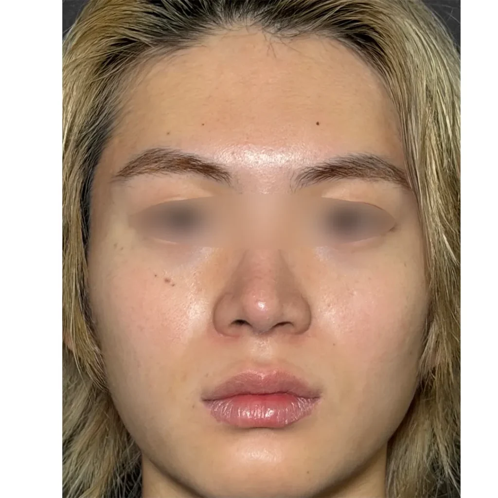 鼻整形_鼻尖形成3D法＋鼻尖軟骨移植＋鼻プロテーゼ＋小鼻縮小 内側法＋小鼻縮小 引き締め縫合＋ボトックス アラガン 小鼻の術後3ヶ月正面（坂本優衣）（267）.png
