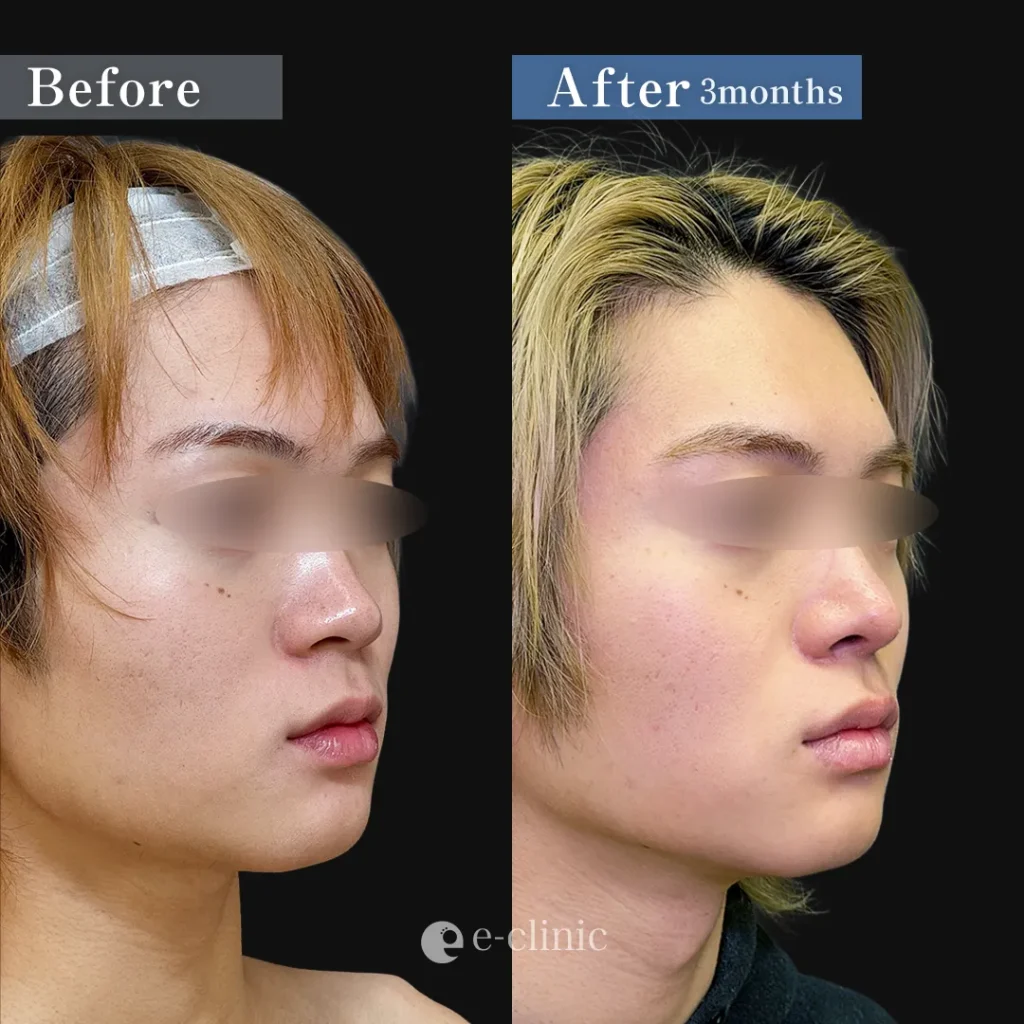鼻整形_鼻尖形成3D法＋鼻尖軟骨移植＋鼻プロテーゼ＋小鼻縮小 内側法＋小鼻縮小 引き締め縫合＋ボトックス アラガン 小鼻_斜め（坂本優衣）（267）