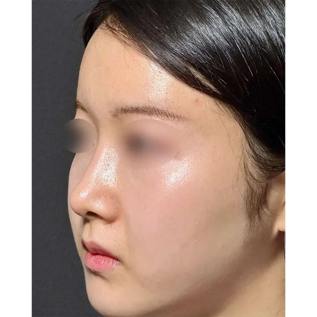 鼻整形_鼻尖形成3D法＋鼻尖軟骨移植＋鼻プロテーゼ＋小鼻縮小 内外側法 引き締め法　術後3ヶ月斜め（坂本優衣）（268）