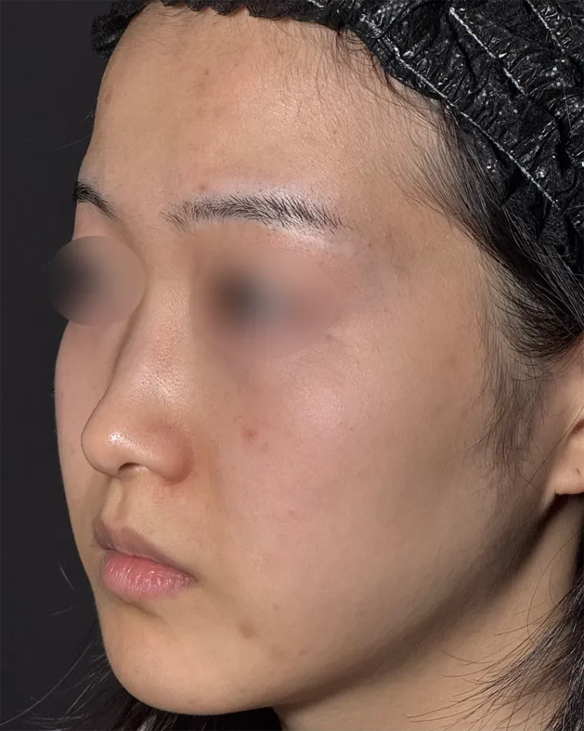 鼻整形_鼻尖形成3D法＋鼻尖軟骨移植＋鼻プロテーゼ＋小鼻縮小 内外側法 引き締め法　術前斜め（坂本優衣）（268）.png