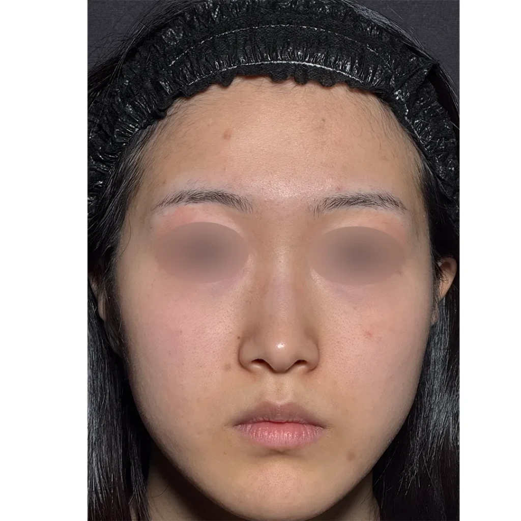 鼻整形_鼻尖形成3D法＋鼻尖軟骨移植＋鼻プロテーゼ＋小鼻縮小 内外側法 引き締め法　正面術前（坂本優衣）（268）