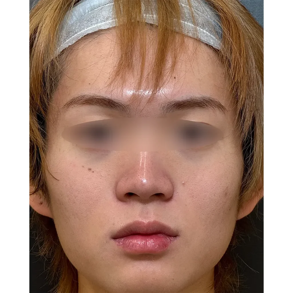 鼻整形_鼻尖形成3D法＋鼻尖軟骨移植＋鼻プロテーゼ＋小鼻縮小 内側法＋小鼻縮小 引き締め縫合＋ボトックス アラガン 小鼻の術前正面（坂本優衣）（267）