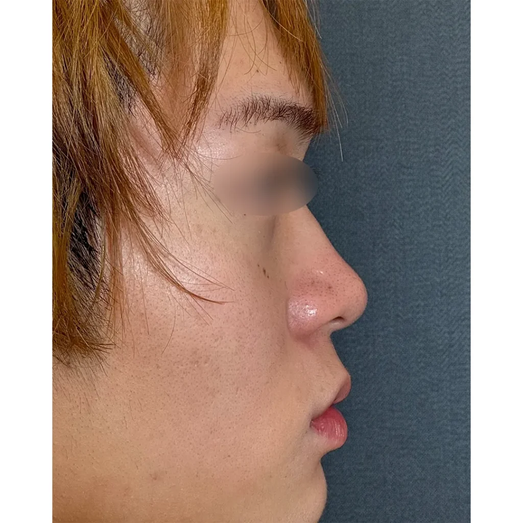 鼻整形_鼻尖形成3D法＋鼻尖軟骨移植＋鼻プロテーゼ＋小鼻縮小 内側法＋小鼻縮小 引き締め縫合＋ボトックス アラガン 小鼻の術前横（坂本優衣）（267）.png