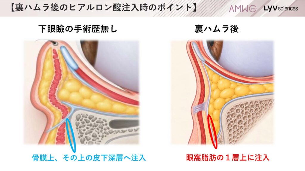 15_裏ハムラ後のヒアルロン酸注入時のポイント