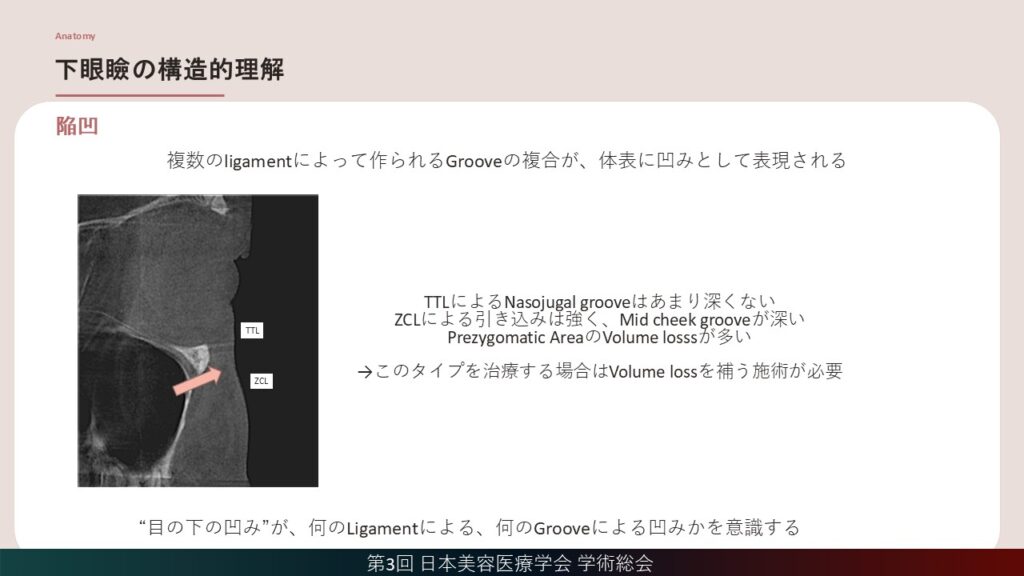7_下眼瞼の構造的理解(陥凹）
