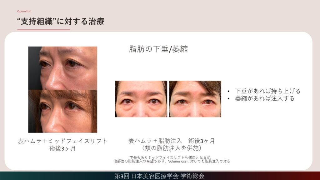 20_表ハムラによるクマの支持組織に対する治療